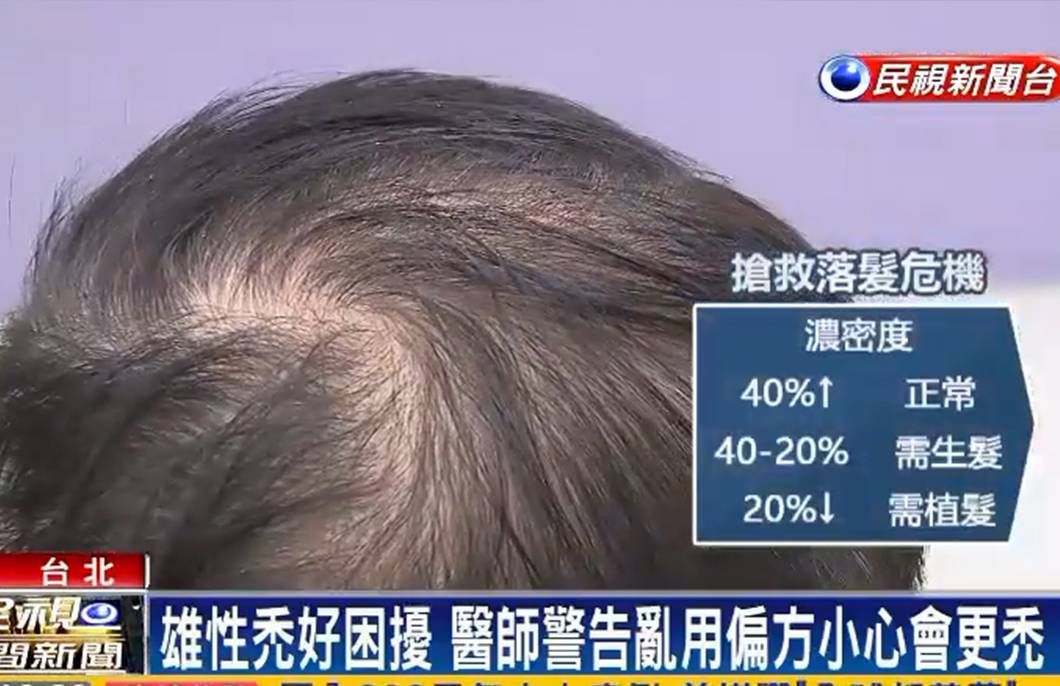 生髮 植髮 禿頭 掉髮 複合式生髮